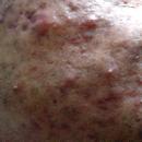 bad cystic acne