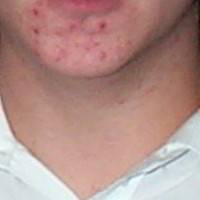 Cystic Acne