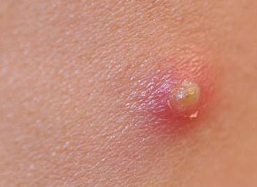 Pimple Vaginal Area