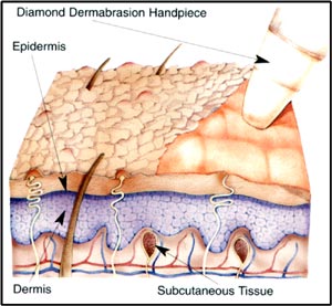 Dermabrasion treatment for acne and blackheads