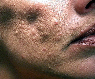 bad acne scars